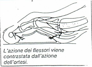 Ortoplastica